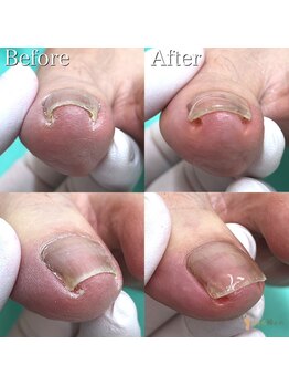 【巻き爪/陥入爪】