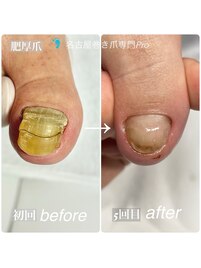 肥厚爪5回目の変化