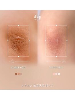 ソレラ(sorelle)/ルメラ肘