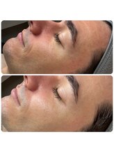 エミレーブ シロカネ(Hemireve Shirokane)/敏感肌の赤み改善