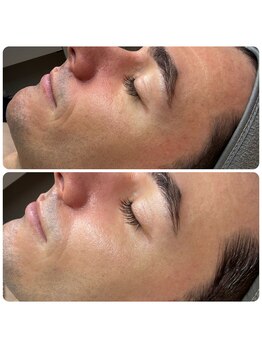 エミレーブ シロカネ(Hemireve Shirokane)/敏感肌の赤み改善