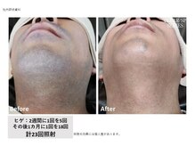 サロン アンネ(Anne)/高松市メンズ脱毛