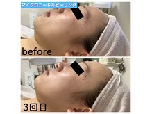 ナチュラル ボーテの雰囲気（マイクロニードルピーリング/ニキビケア/小ジワケア/シミケア）