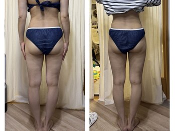 リュミエール(Lumiere)/8回目のBefore After 30代女性