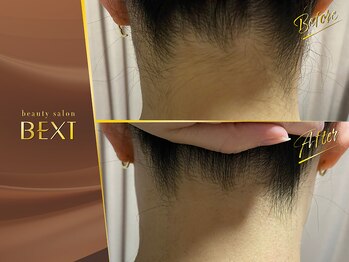 ベクスト(BEXT)/うなじ・背中脱毛(PRO)