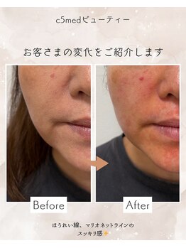 シーファイブメットビューティ 西11丁目店(C5medビューティ)/ビフォーアフター
