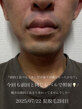 コモレビ(comorebi)/髭脱毛体験談　2回目