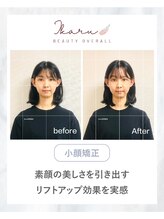 イカル 池袋(ikaru)/小顔矯正 before after 