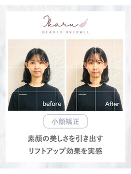 イカル 池袋(ikaru)/小顔矯正 before after 