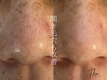 フレキシ 表参道(Flexi)の雰囲気（毛穴の詰まりや開きにはピーリングの酸と保湿力が必須◎）