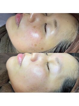 ホワラ 横浜店(Whila)/施術効果3