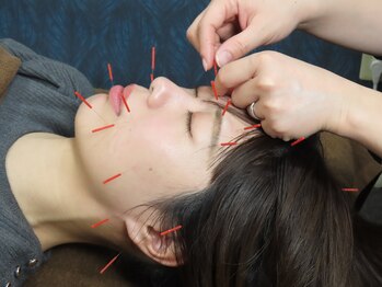 キュライム 熊本(CURAIM)/美容鍼