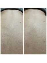 ジョエルワックス 沖縄糸満店(JOELLE WAX)/細かい産毛もサヨナラ！