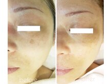 ラヴィアンローズ(La vie en Rose)/シミケアコース