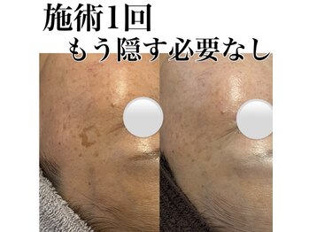 サロンツキ(salon tuki)/【光フェイシャル症例】