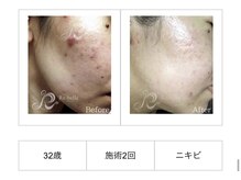 SDルーム/リベルハーブピーリング