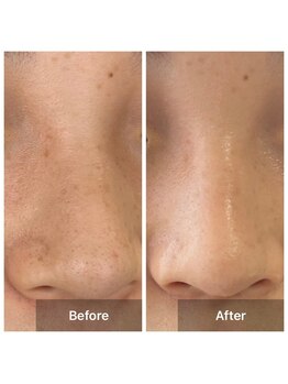 サロン ド アヤ(salon de Aya)/一回施術後シミの改善