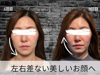 ハリユナイテッド 原宿鍼灸 整体院(HALI UNITED)/美容鍼で左右差ないお顔へ!