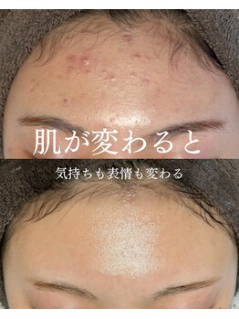 インテリウス(INteRius.)/揺らぎ肌ケア