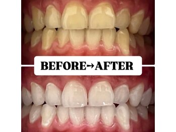 ホワイトニングサロン 豊中/Before&After美白ホワイトニング