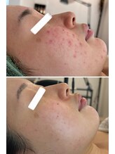 美時雨/ニキビにお悩みの方！