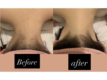 アゼリア 本厚木店(AZALEA)/【施術症例】うなじ脱毛