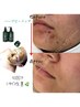 ＼究極の美肌ケア／【ハーブピーリング&ヒアルロン酸注入】陶器肌へ