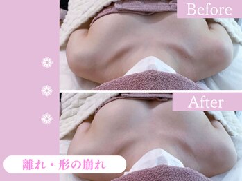 キアナ 横浜店(Kiana)/離れにお悩みの方Before After