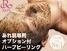 【ニキビケア】1年以上お悩みのニキビケアハーブピーリング 定価¥16500