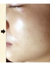 ノットノット 自由が丘(Not Knot)/２.グリーンピール 5days 3回後