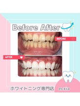 エクシアホワイトニング 札幌琴似店/ビフォーアフター