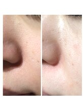 すっぴん美肌革命/毛穴の黒ずみすっきりつるん肌へ