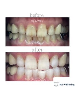 NAホワイトニング 自由が丘店/【before/after】