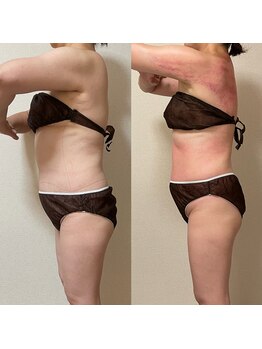 プラウディア(PROUDIA)/スリム/痩身エステ/痩せる／痩身