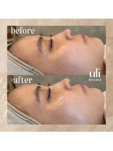 ウリ(uli beauty)/比較写真