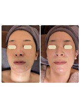 プライベートサロン 美月/ニキビケア　毛穴　艶肌