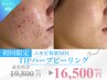 【 ニキビケア効果No1】TIPハーブピーリング&マシン150分¥19800→¥16500