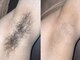NTエステティック 西条店の写真/【脱毛デビューにオススメ★】こだわり抜いた痛みの少ない本格施術◎お得に理想のツルスベ肌へ導きます♪