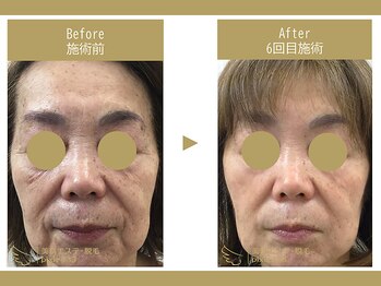 ピクシー433(pixie433)/リフトアップ&美白エステ♪