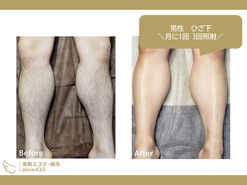 ピクシー433(pixie433)/男性 ひざ下 月に1回 3回照射