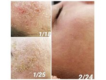 ベルジュール 岩国店の雰囲気（プラズマゼノ１回。トラブルのない強い肌へと導きます。）