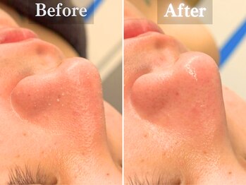 ボーンオム(Born Homme)/毛穴洗浄＋美容液導入：20代女性