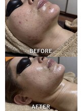 エシャーム(echarme)/Eライト 肌質改善　引き締め