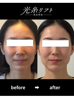 ヘルディン(heldin +555)/光糸リフト