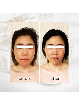 シュシュ(shushu)の写真/続けるほど際立つメリハリ小顔★本格コルギで代謝をアップし、メリハリのある立体的な美ラインへ♪