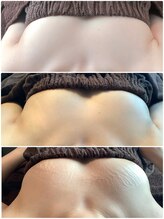 ラポッシュ(La poche)/バストアップ症例写真