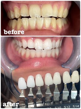 エクシアホワイトニング 新小岩店/ホワイトニングビフォーアフター