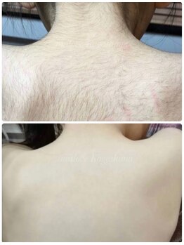 ミーラブ 鹿児島(miilove)/実績多数のキッズ脱毛