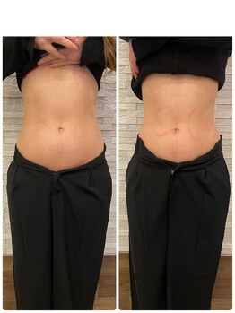 長寿鍼灸院 長寿整骨院/EMS<お腹集中コース>