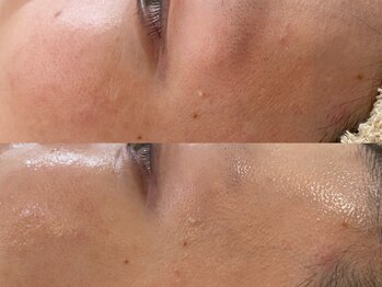 ブラン ネージュ(Blanc Neige)/レストセルトリートメント